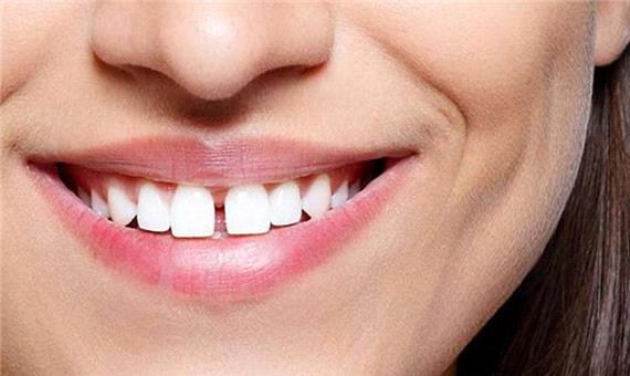 عوارض فاصله زیاد بین دندان‌ها